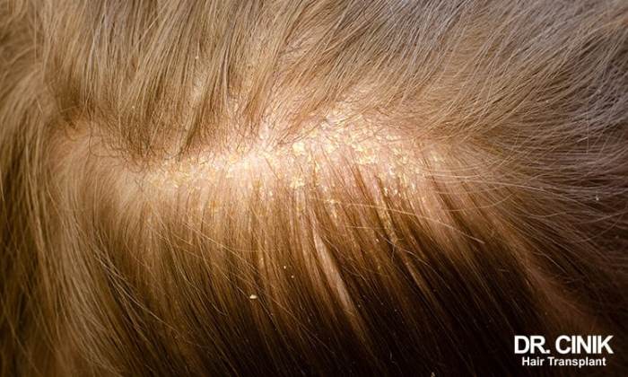 Scalp Folliculitis Natural Treatment Scabs on scalp causes diagnosis and treatment