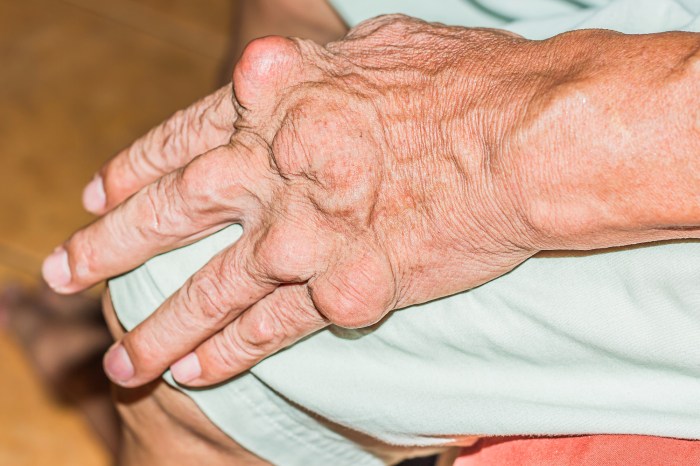 Gout vs Rheumatoid Arthritis A Deep Dive
