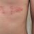 Shingles Vaccine Side Effects A Deep Dive