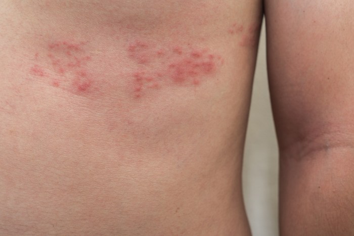 Shingles vaccine side effects