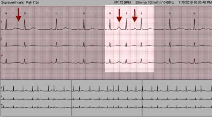 Premature Atrial Contractions Premature atrial complexes pacs