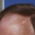 Skin Cancer on Scalp A Comprehensive Guide