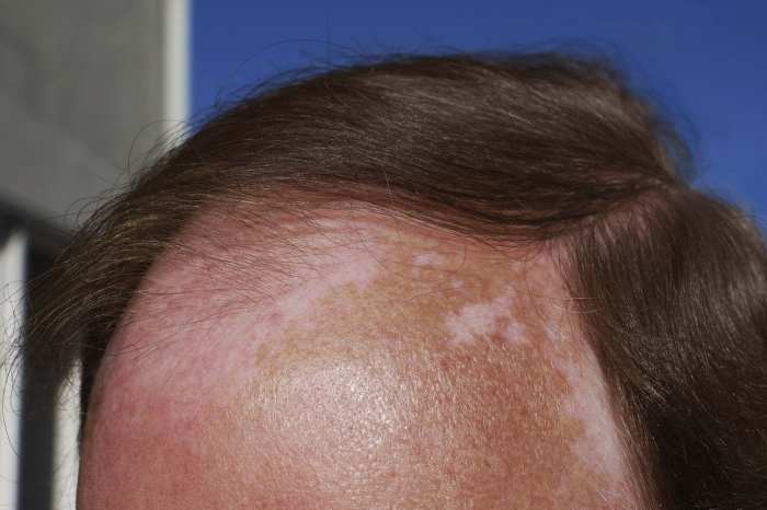 Pink spot on scalp. cancer or something else? : r/Dermatology Skin cancer on scalp