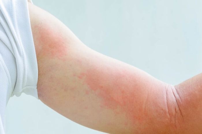 Itchy skin at night