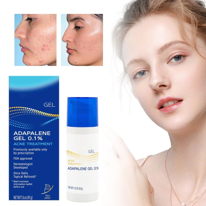 Acne treatment with topical retinoids