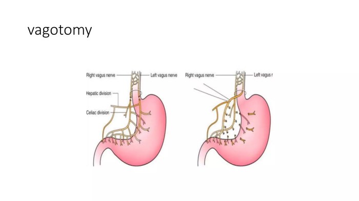 Surgical treatment for peptic ulcer disease | PPT Surgery for peptic ulcers