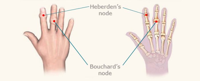 What are Heberdens Nodes Understanding the Basics