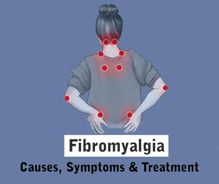 Fibromyalgia Treatment: Medications, Exercise, Diet, and More Fibromyalgia and weather changes