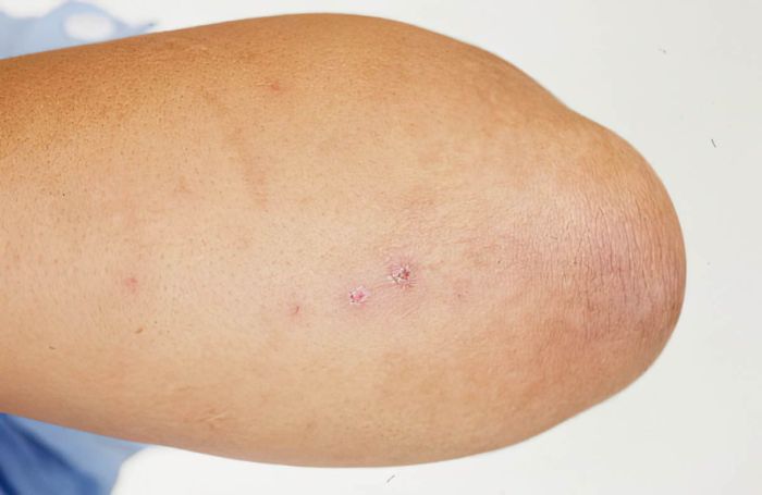 What Does Gonorrhea Look Like? What does gonorrhea look like
