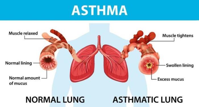 Asthma your immune system