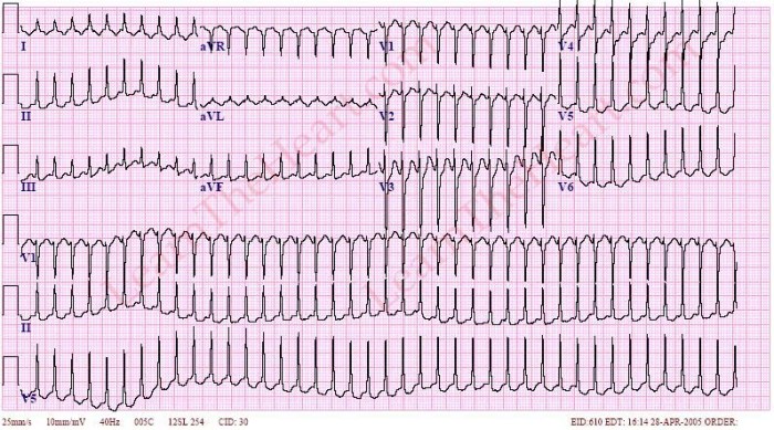 Atrioventricular Reentry Tachycardia (AVRT) ECG Example | LearntheHeart.com Atrioventricular reentrant tachycardia avrt