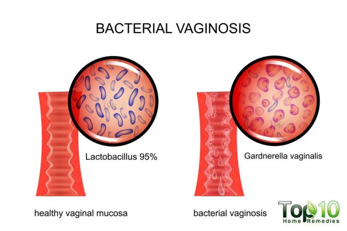 Bacterial vaginosis in men