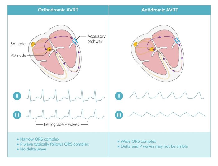 A: Slow-fast atrioventricular nodal reentrant tachycardia induced in... | Download Scientific ... Atrioventricular nodal reentrant tachycardia avnrt