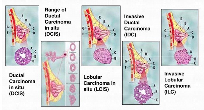 Breast cancer staging stage zero