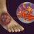 Fungating Breast Cancer Wound Care Relief