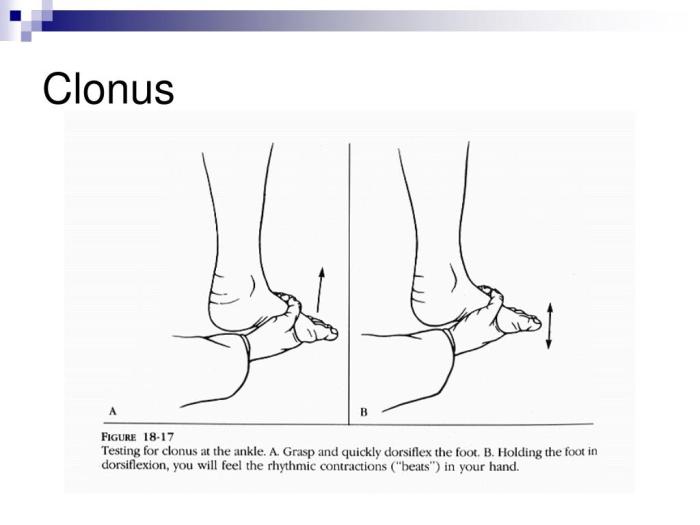 Clonus causes diagnosis and treatment