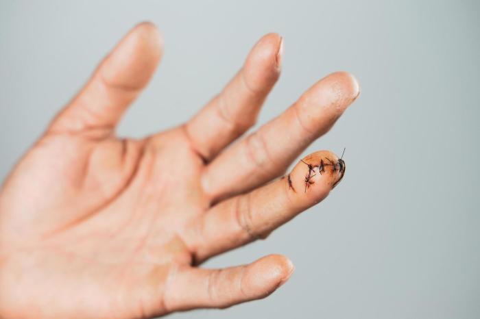How to Treat a Cut Finger A Comprehensive Guide