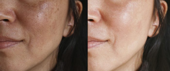 Tranexamic acid for skin