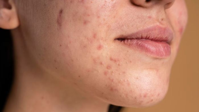 Causes of dark spots