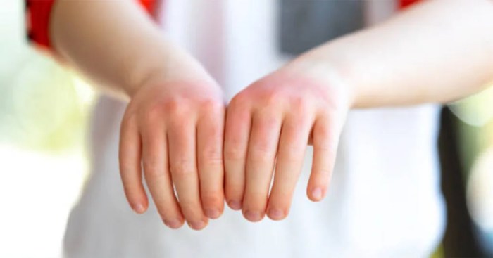 Gluten Allergy Signs of gluten allergy