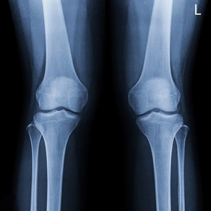 Knee pain when walking