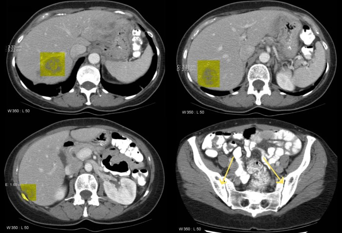 Metastatic Breast Cancer - Comprehensive Guide Combating isolation when diagnosed with metastatic breast cancer