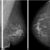 Radial Scars A Benign Breast Abnormality