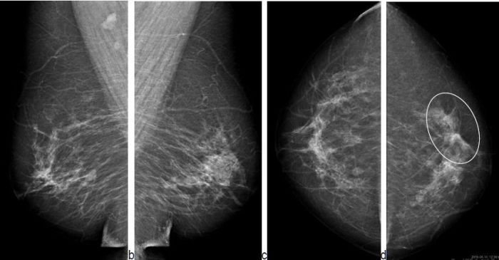 Radial scars a benign breast abnormality