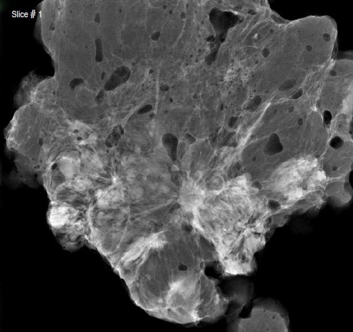 Radial Scars and Invasive Breast Cancer Radial scars a benign breast abnormality