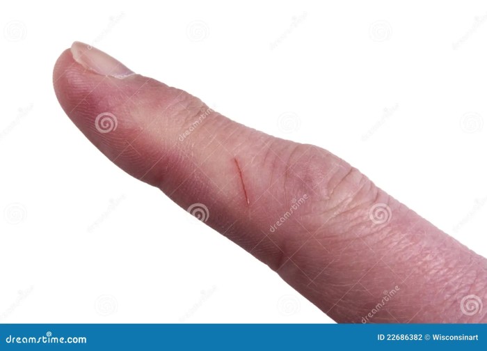 How to treat a cut finger