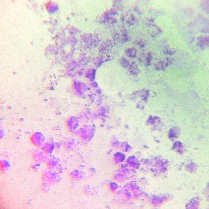 What does gonorrhea look like