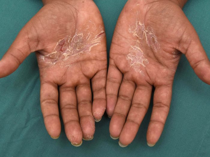 Eczema and Sun Exposure A Comprehensive Guide