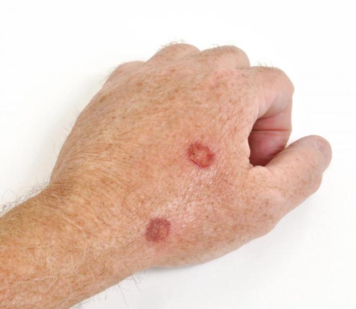 What are Precancerous Cells? (with pictures) What are precancerous cells
