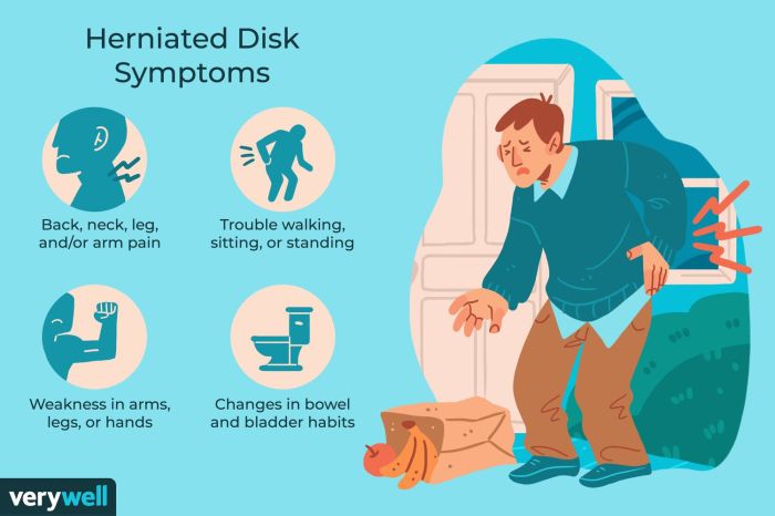 Herniated Disc Surgery Overview A Comprehensive Guide