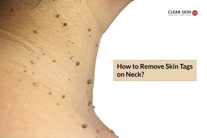 How To Prevent Skin Tags - Ask The Nurse Expert How to prevent skin tags