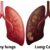 Lung Nodules Symptoms Causes and Diagnosis