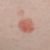 Non Cancerous and Pre-Cancerous Skin Lesions Explained
