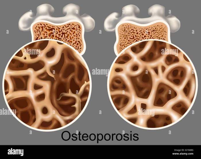 Is osteoporosis a disability