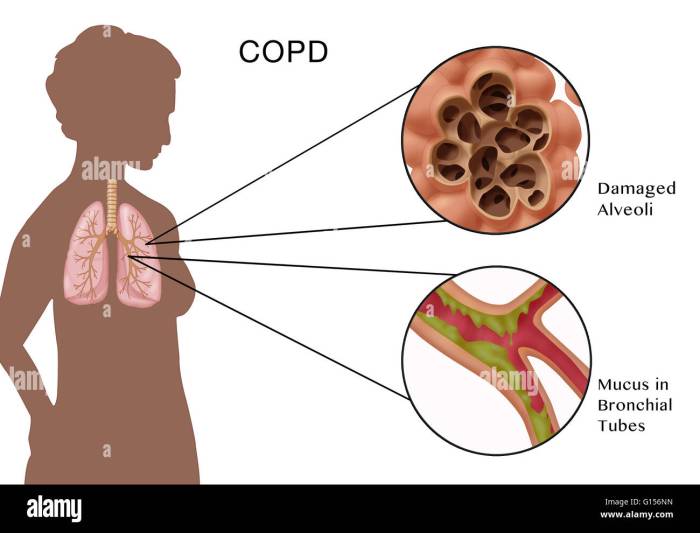 Chronic Obstructive Pulmonary Disease Copd Copd and herbal remedies
