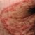 Jock Itch Tinea Cruris Fungal Infection Explained