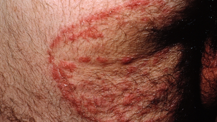 Home Remedies for Jock Itch – Entirely Health Jock itch tinea cruris fungal infection