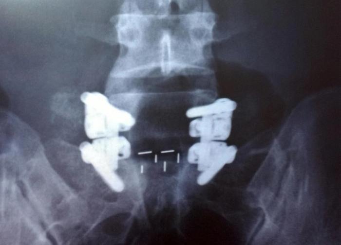 Lateral L5/S1 spot x-ray shows spondylolytic spondylolisthesis at L5-S1. | Download Scientific ...
