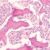 Treatment for Metastatic Castration-Resistant Prostate Cancer