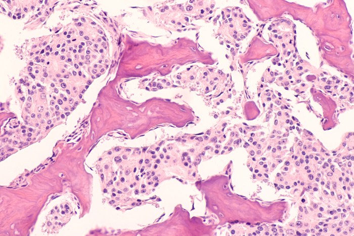MCRPC in focus - Medthority Treatment for metastatic castration resistant prostate cancer