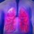 Lung Cancer in Women A Comprehensive Guide