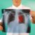 Immunotherapy for Lung Cancer A Comprehensive Guide
