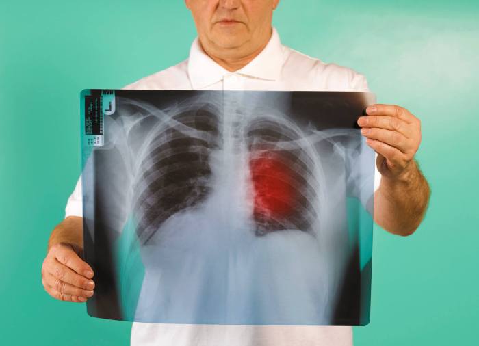 Different types of immunotherapy for lung cancer treatment Immunotherapy for lung cancer