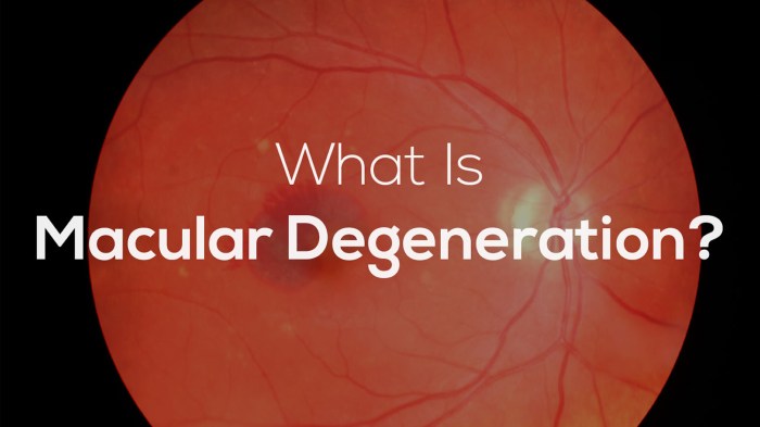 What to Know About Macular Degeneration | Wilmington Family Eye Care Macular degeneration coping support and living well