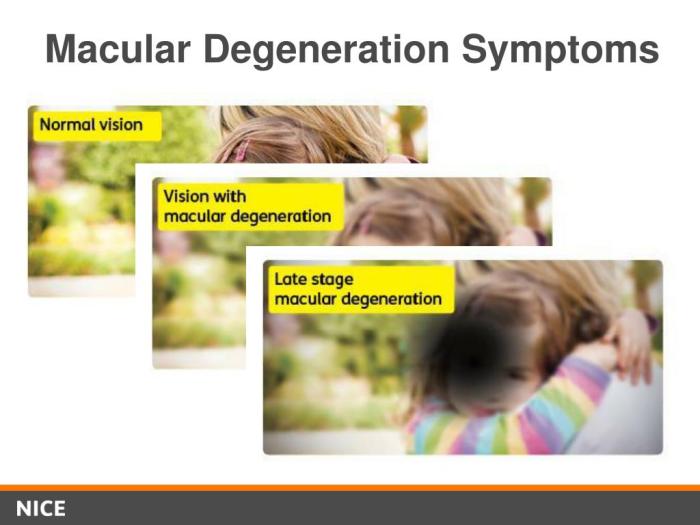 Do you have macular degeneration symptoms? Know the Premilife way