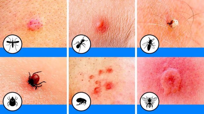 Tips to Prevent and Treat Bug Bites | Upstate Dermatology How to treat bug bites